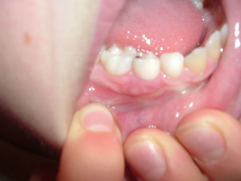 hole in gum