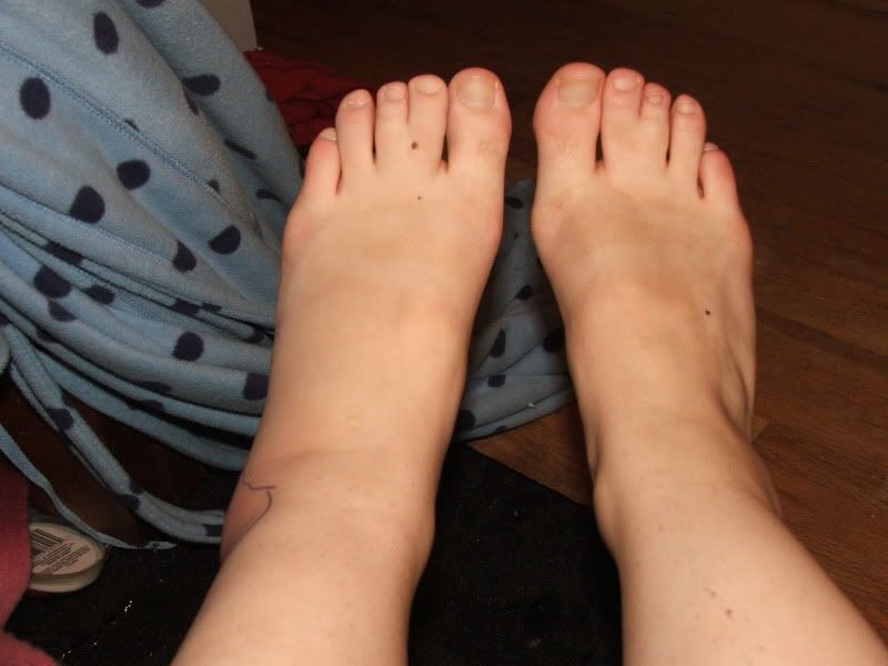 How painful is a sprained ankle? And what has turned out to be more ...